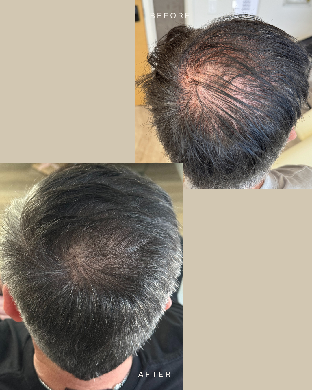 Comparison of a man's scalp before and after hair restoration, showing thickening and coverage improvement.