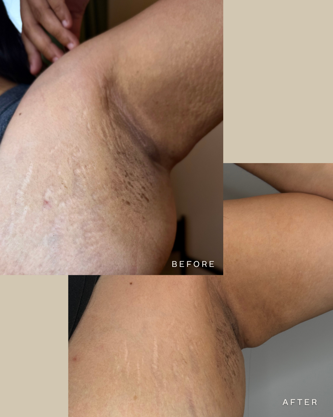 Comparison of armpit skin before and after treatment, showing improved skin texture and reduced dark spots in the after image.