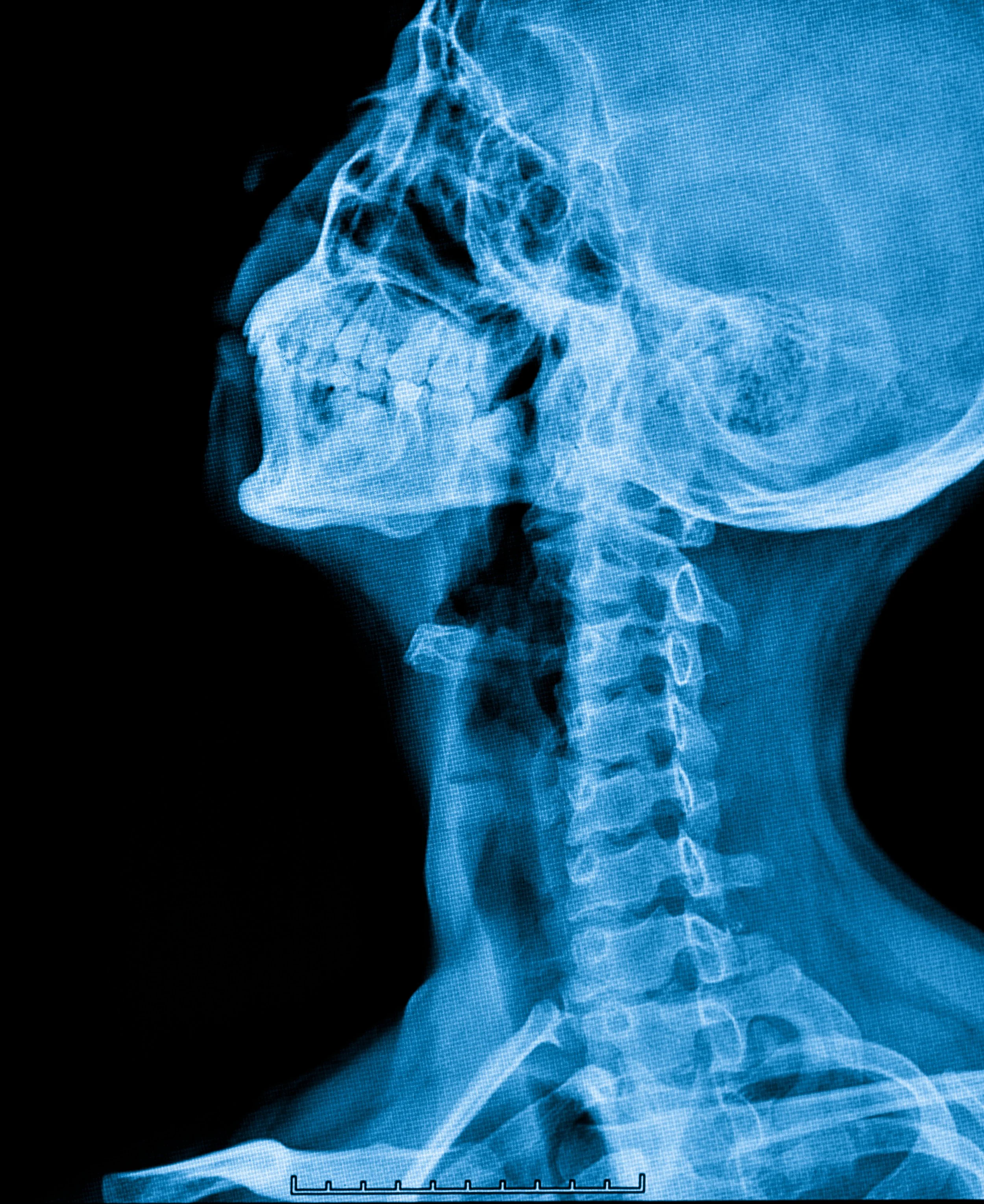 X-ray image of a human skull showing detailed bone structure and teeth.