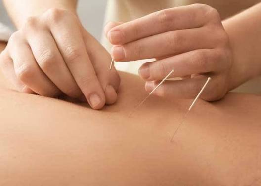 A person receiving dry needling in Wagga.