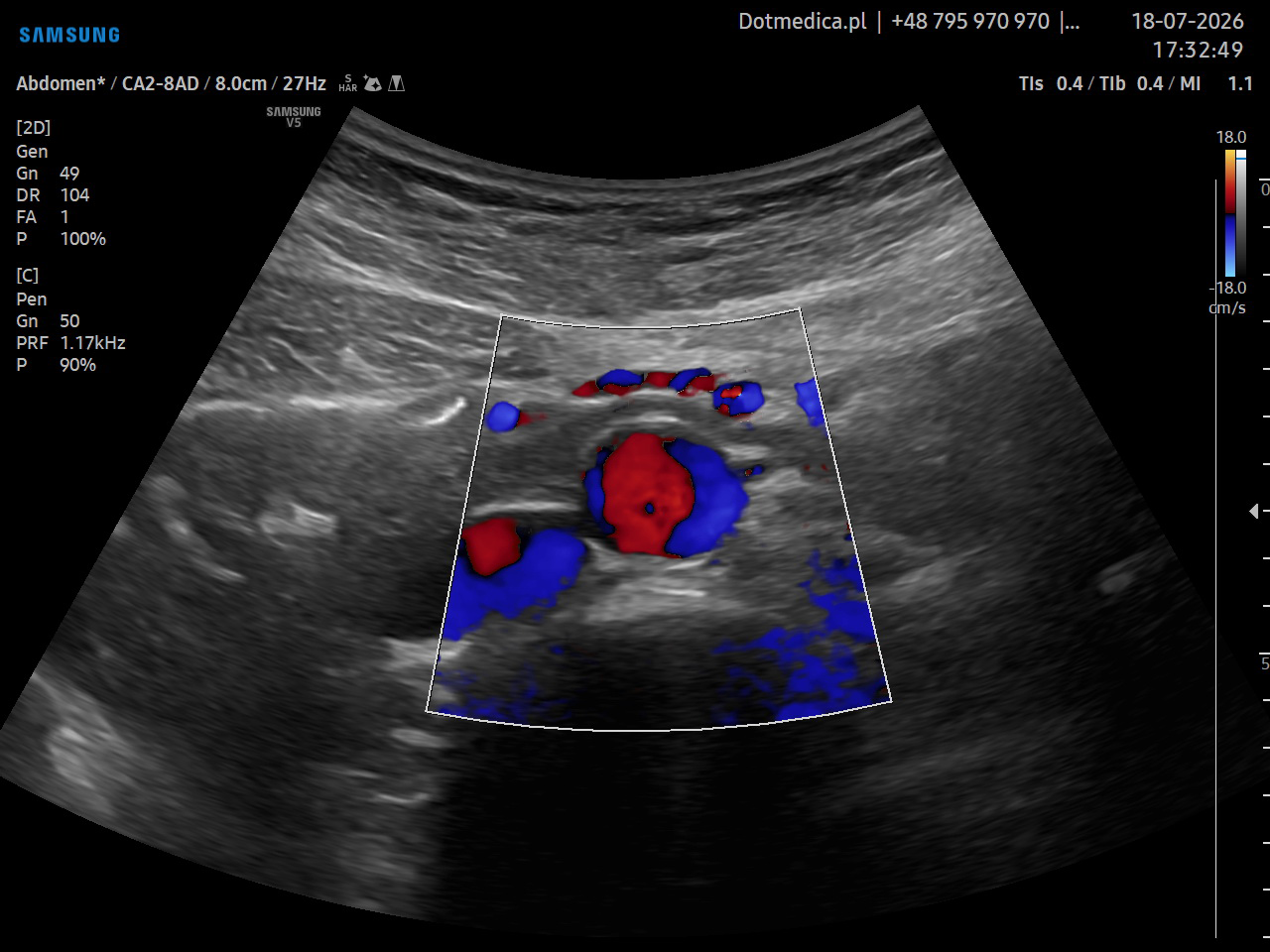 USG Doppler aorty brzusznej i tętnic biodrowych