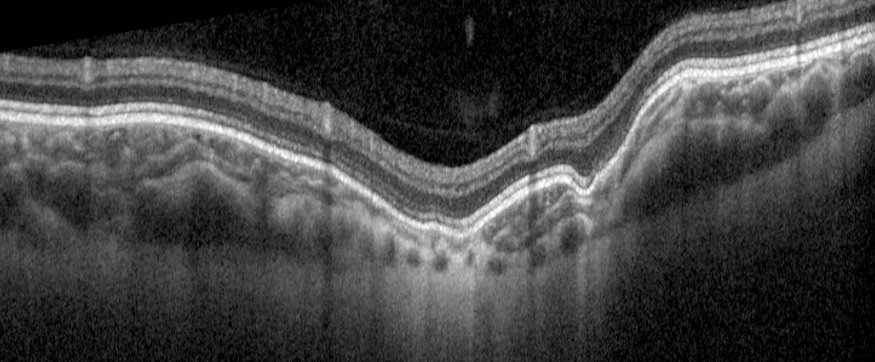 Black and white image of an eye's retina, showing detailed layered structure.