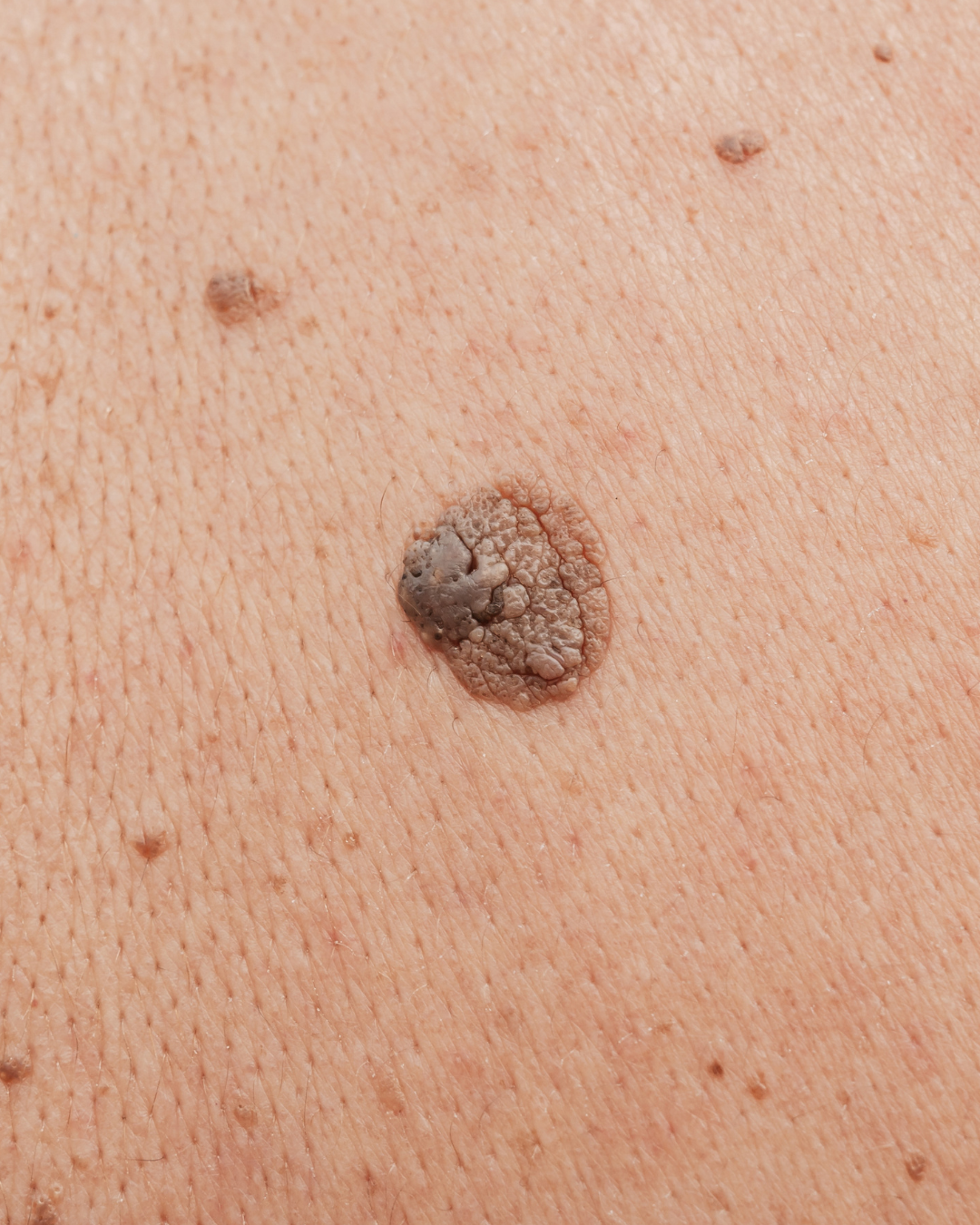 A close up of a raised mole on someone's skin