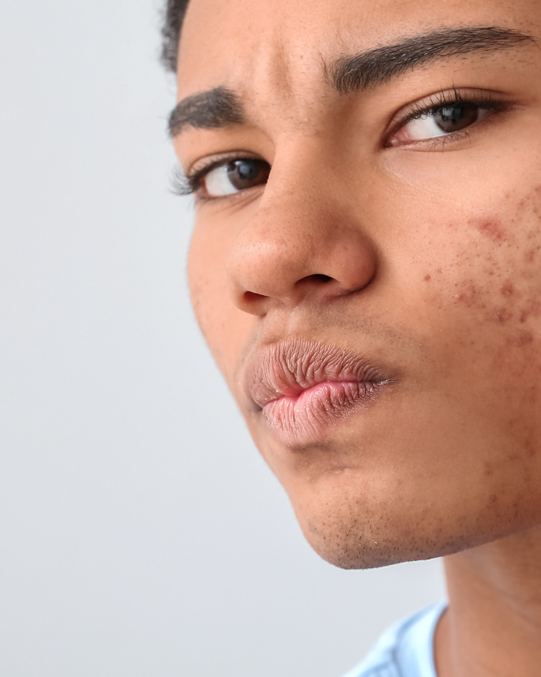 A man with acne on his cheeks.