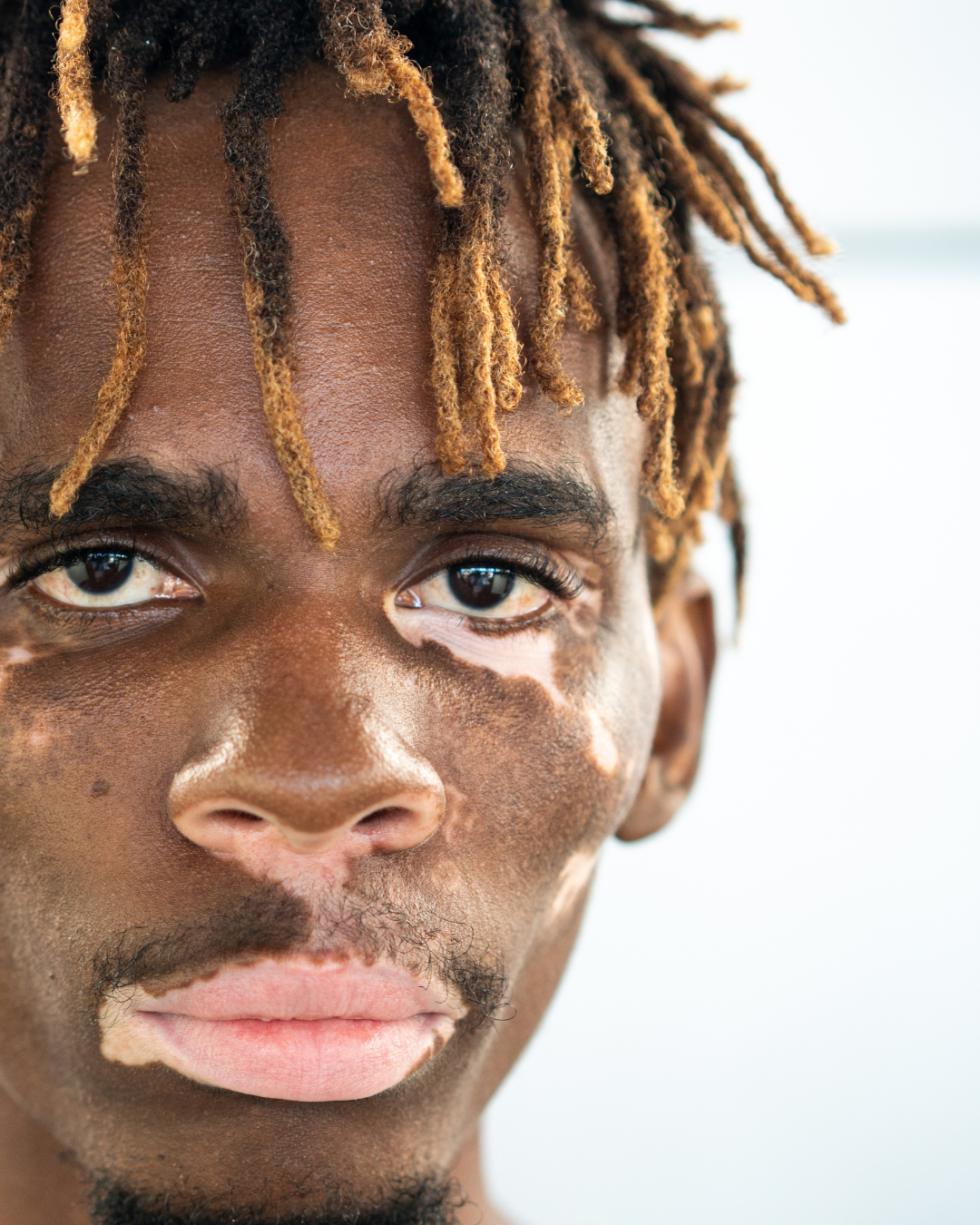 A close up of the face of a man with vitiligo