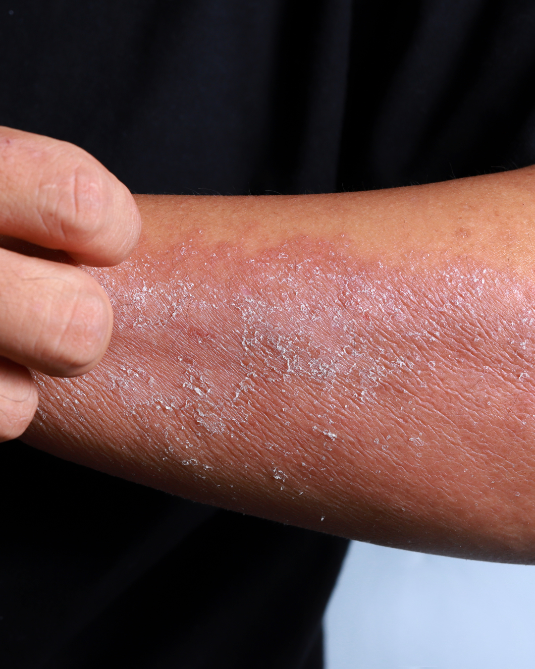 A close up of a man's arm, affected by inflammatory skin disease.