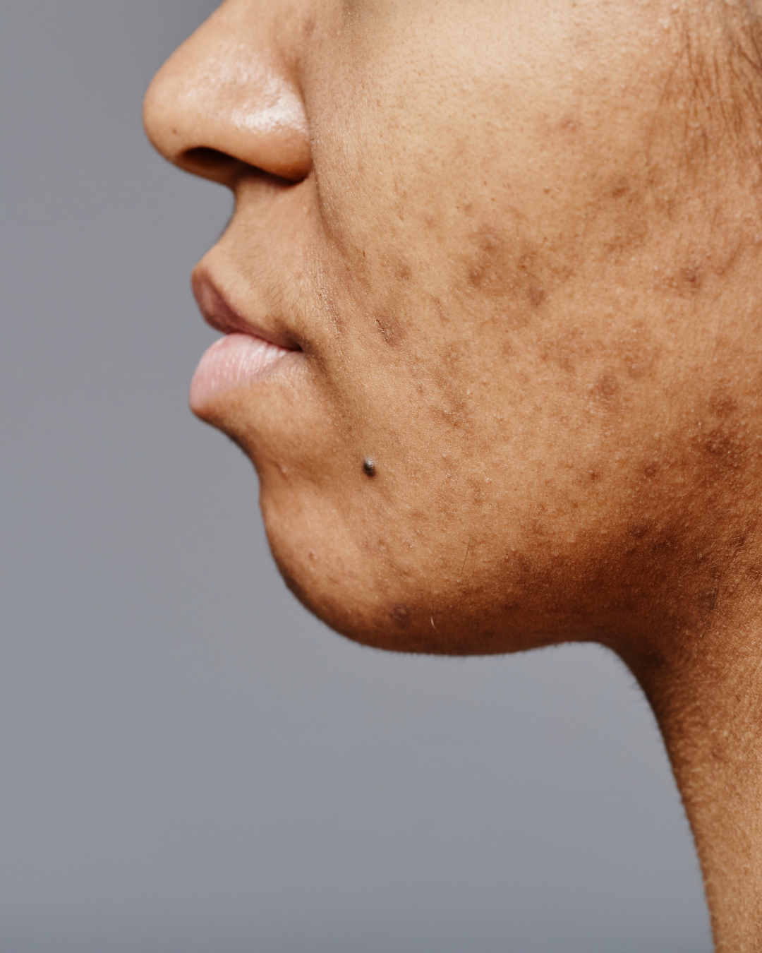 A close up of a woman's face, her cheeks and jaw line feature acne scars.