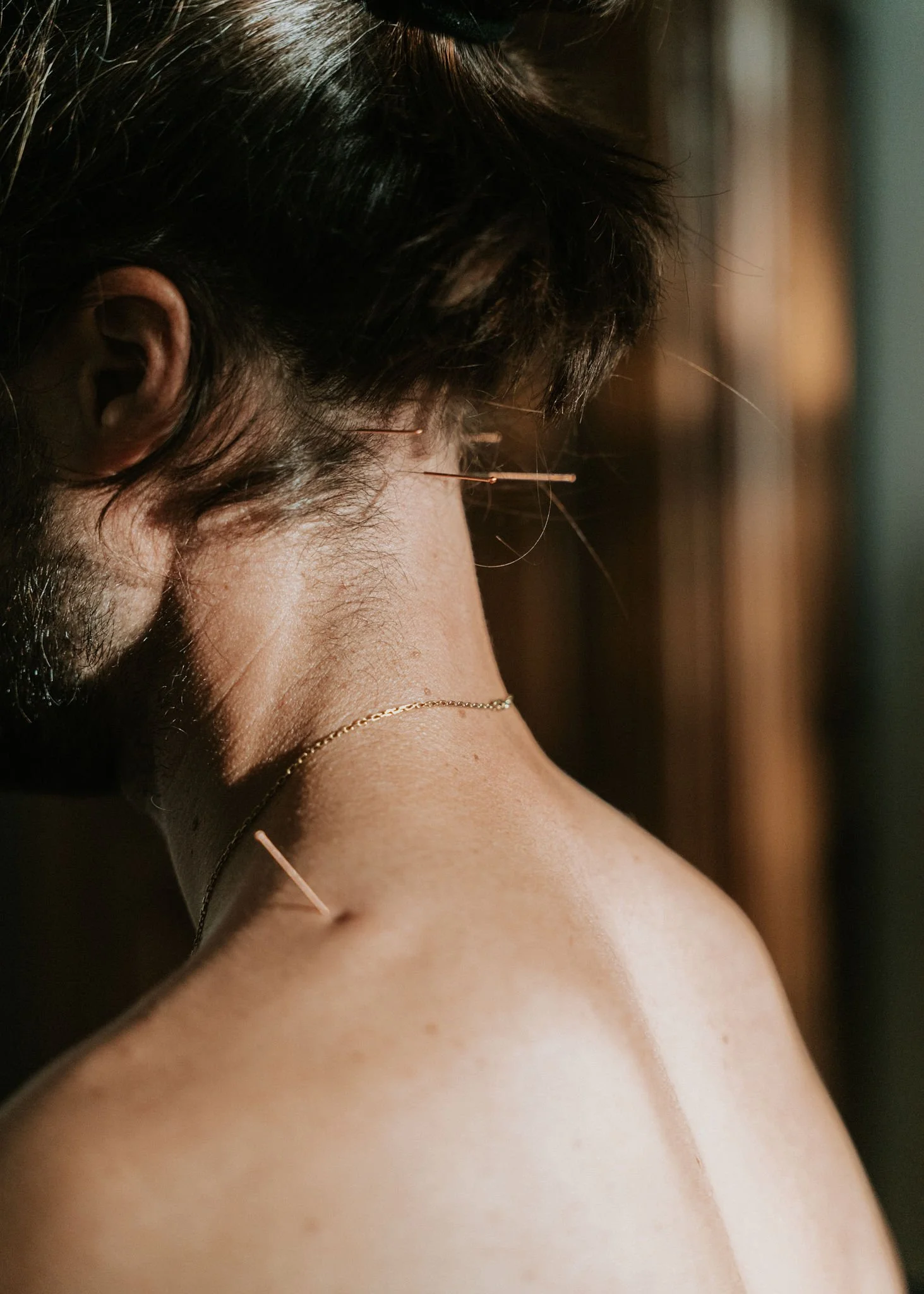 Close-up van een persoon met donkere haar en een goudketting op de schouder, met acupunctuurnaalden in het hoofd en de nek.