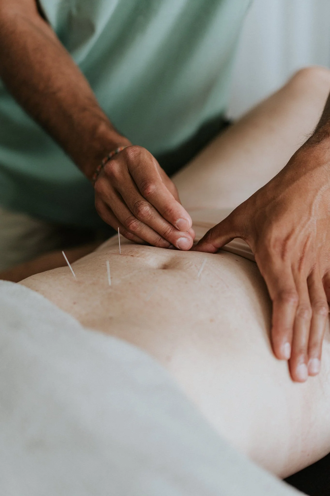 Een vrouw ontvangt een acupunctuurbehandeling met naalden in de buik.