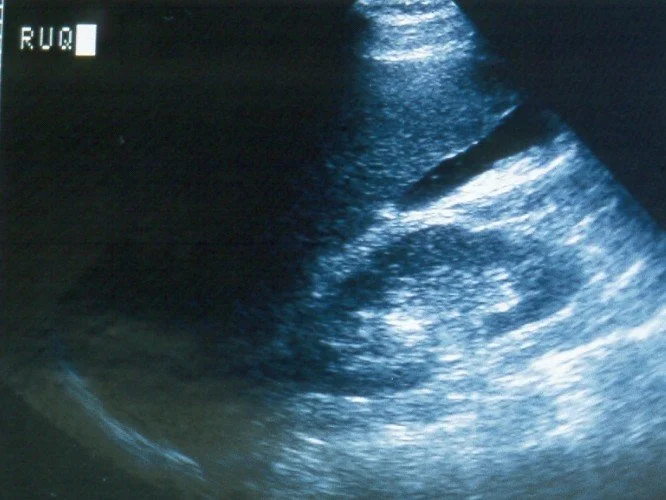 Ultrasound image showing a developing fetus inside the womb.