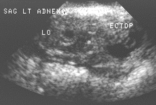 Ultrasound image showing a gestational sac with labels for LO and ECTOP, indicating early pregnancy.