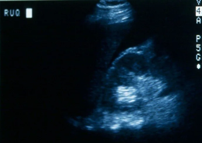 Ultrasound image of a fetus inside the womb.