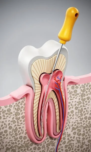 Root Canal Treatment