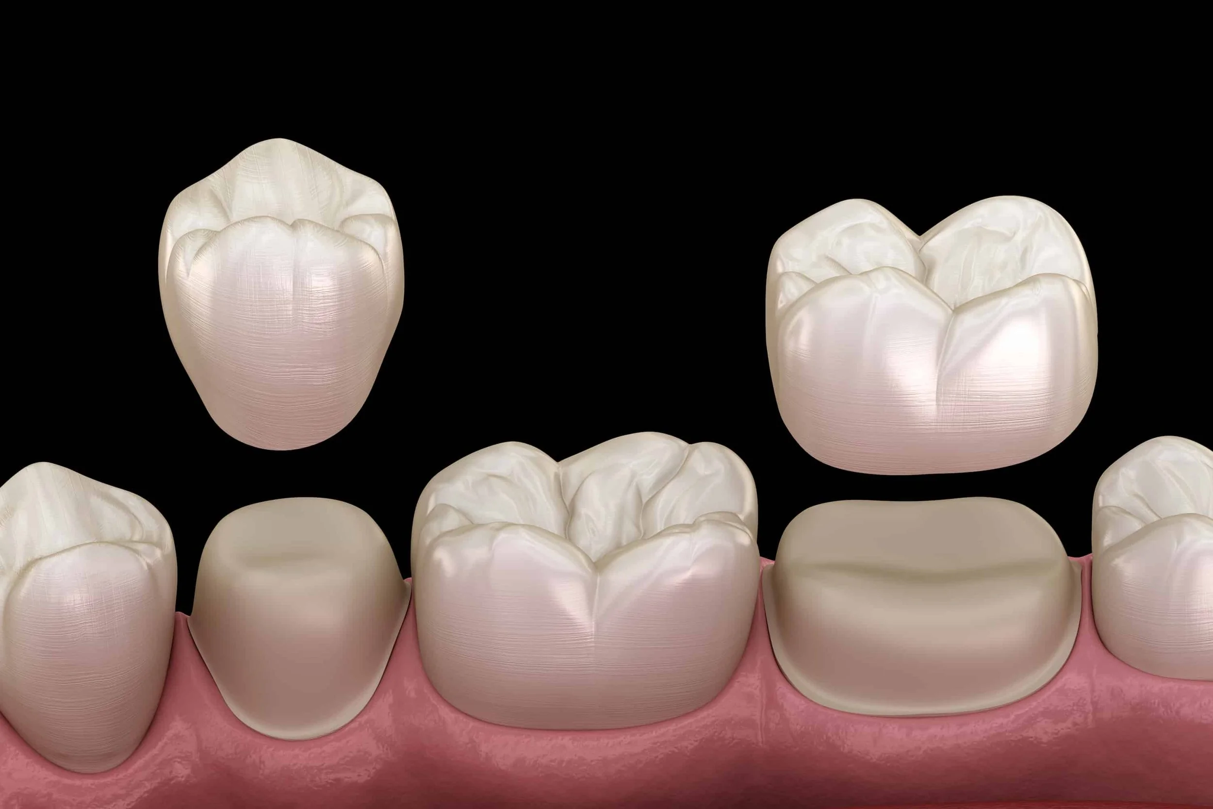 Dental Crowns and Bridges