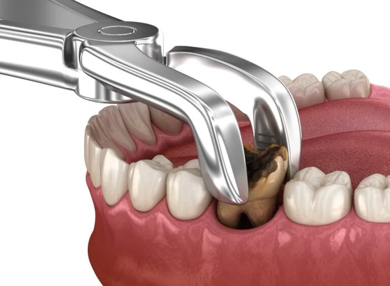 Extractions