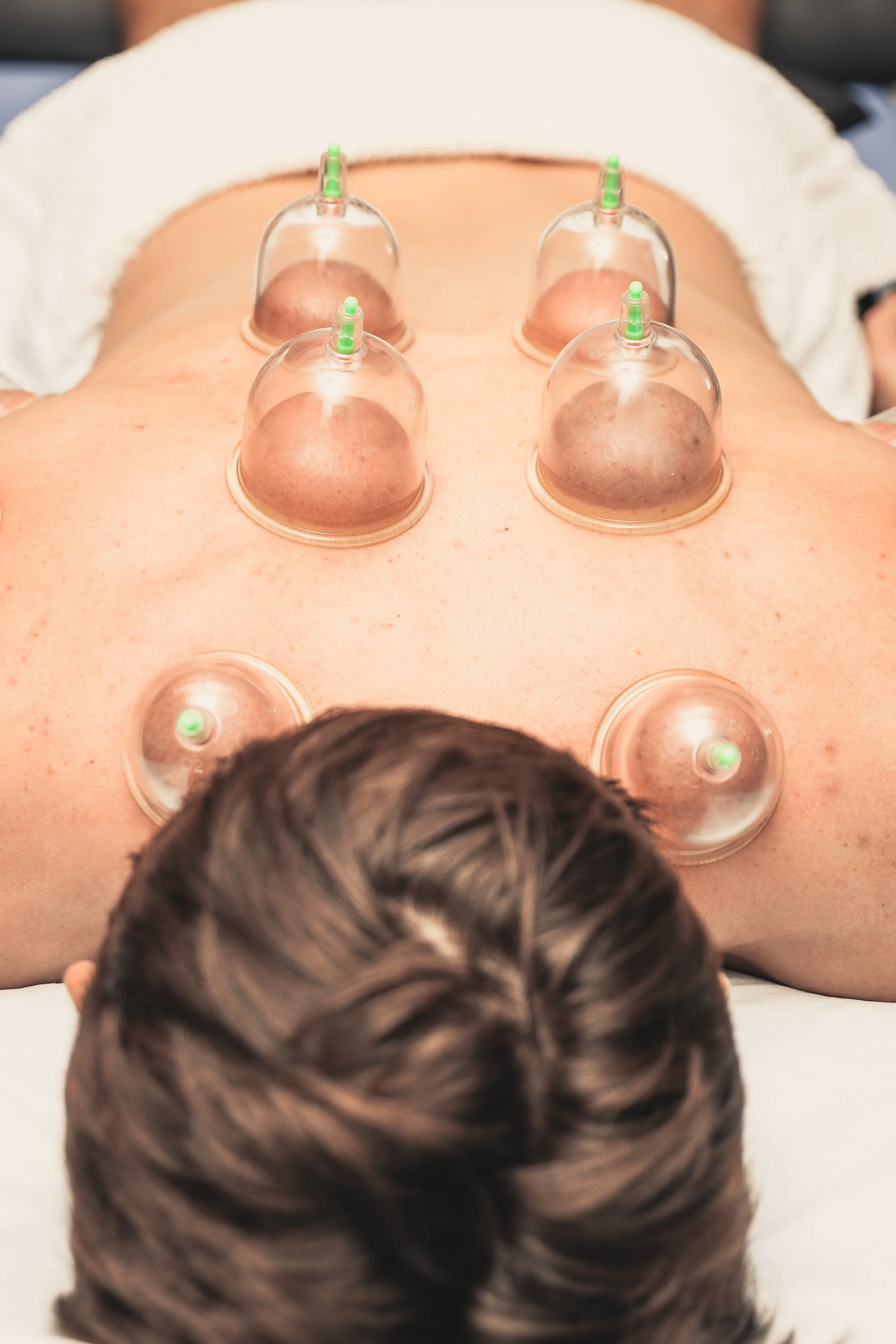 Person lying face up on a massage table receiving cupping therapy with multiple glass cups placed on their back.