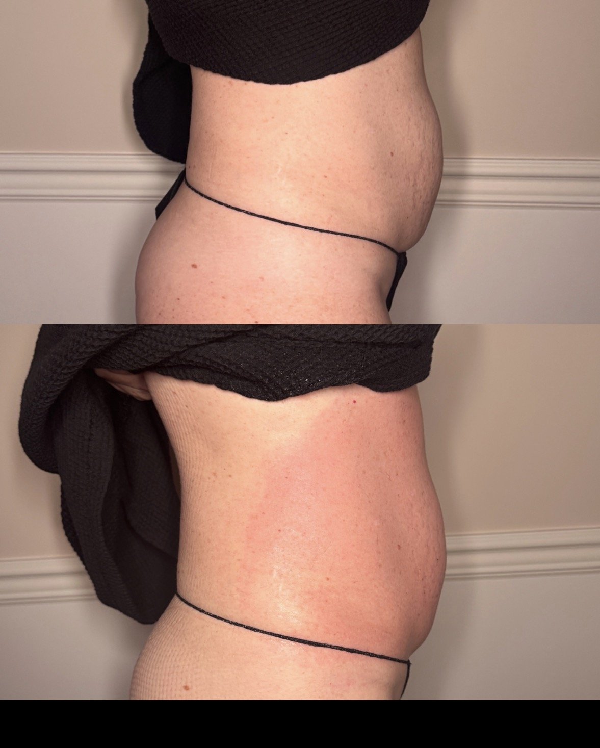 Body sculpting treatment