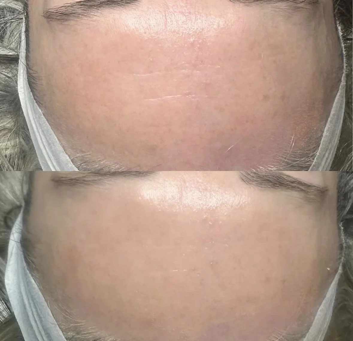 hydrafacial Shrewsbury