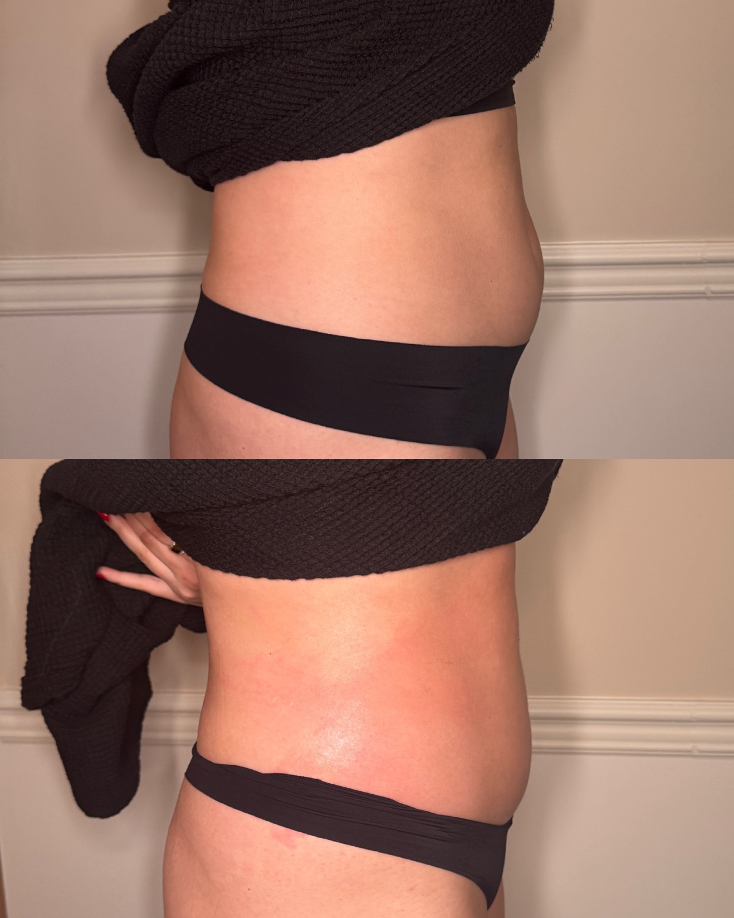 body sculpting Shrewsbury NJ