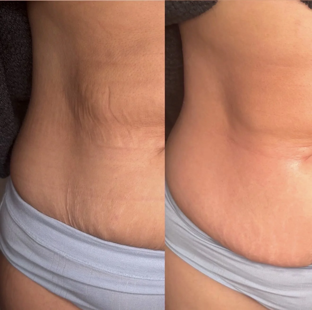 body contouring NJ