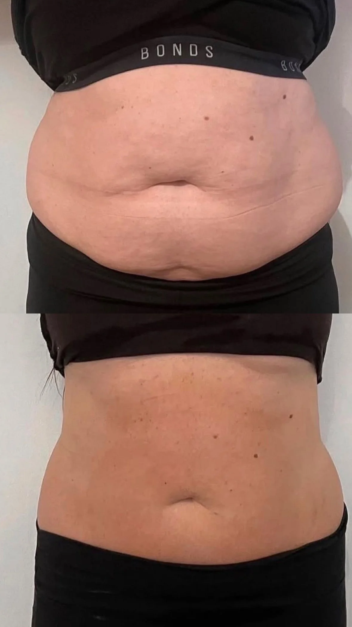 lymphatic drainage Shrewsbury