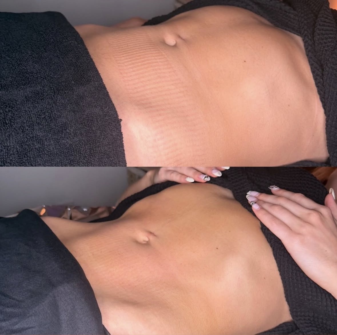 Body sculpting treatment