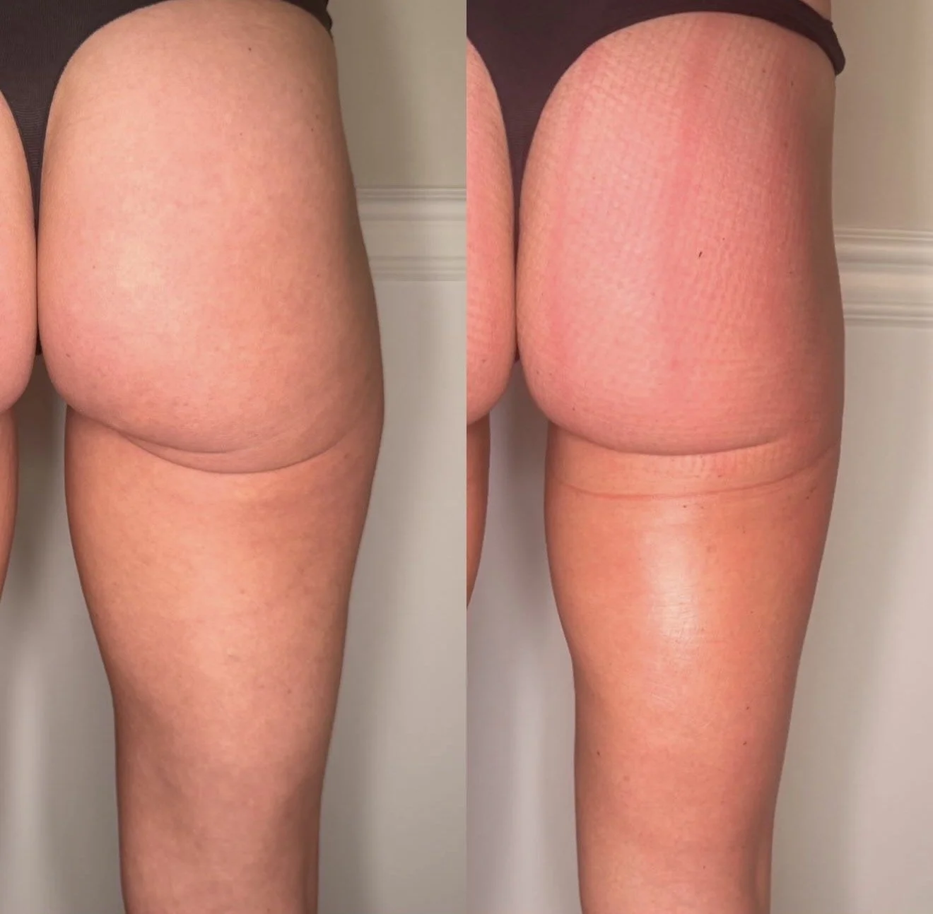 Body contouring before after