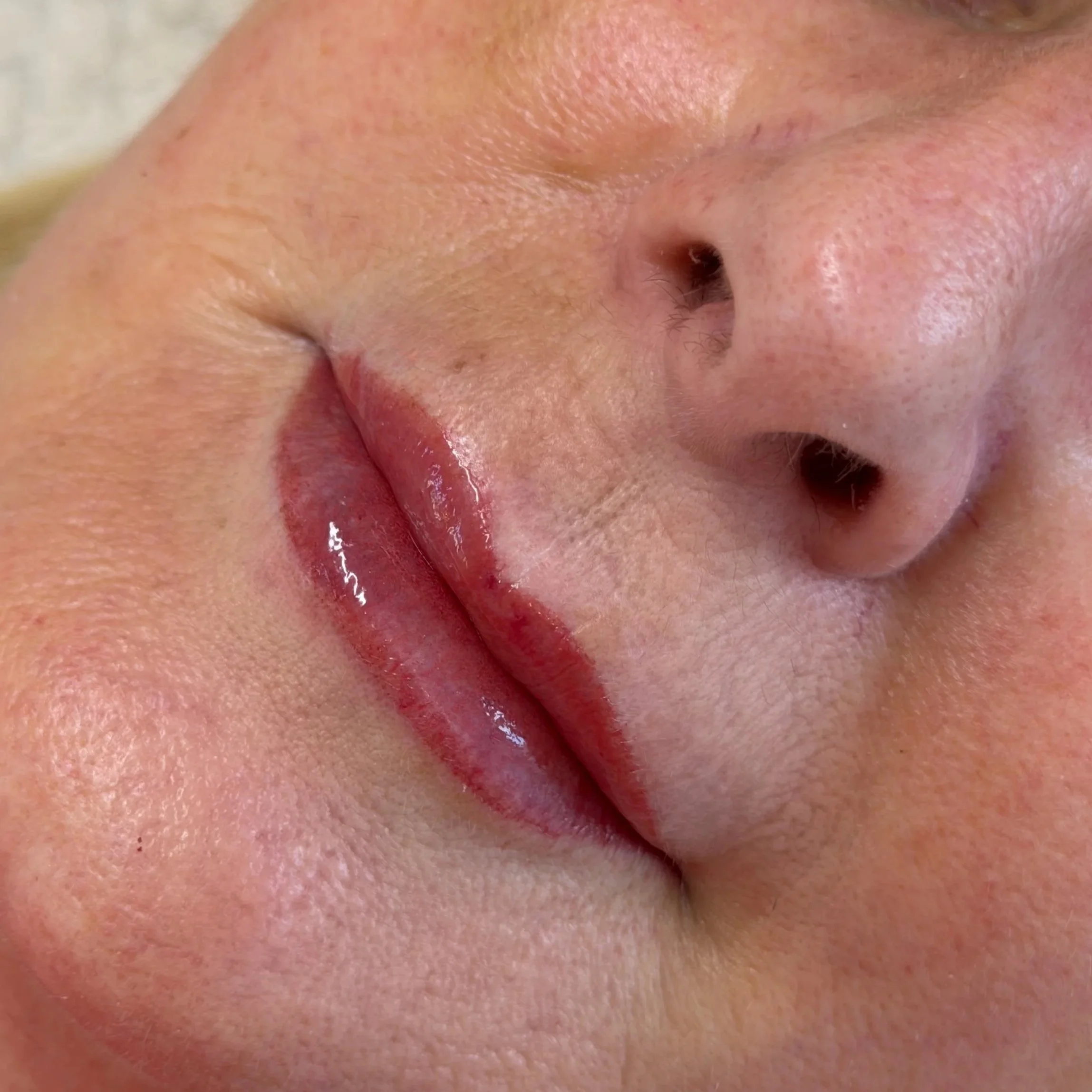 Close-up of a person's nose and lips with visible skin texture, pores, and some redness.