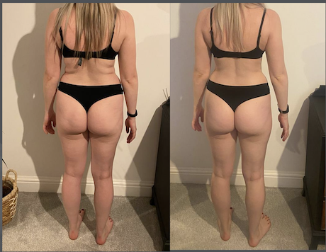 Side-by-side comparison of a woman's back, showing improvement in body tone and reduction in body fat after a fitness or weight loss regimen.