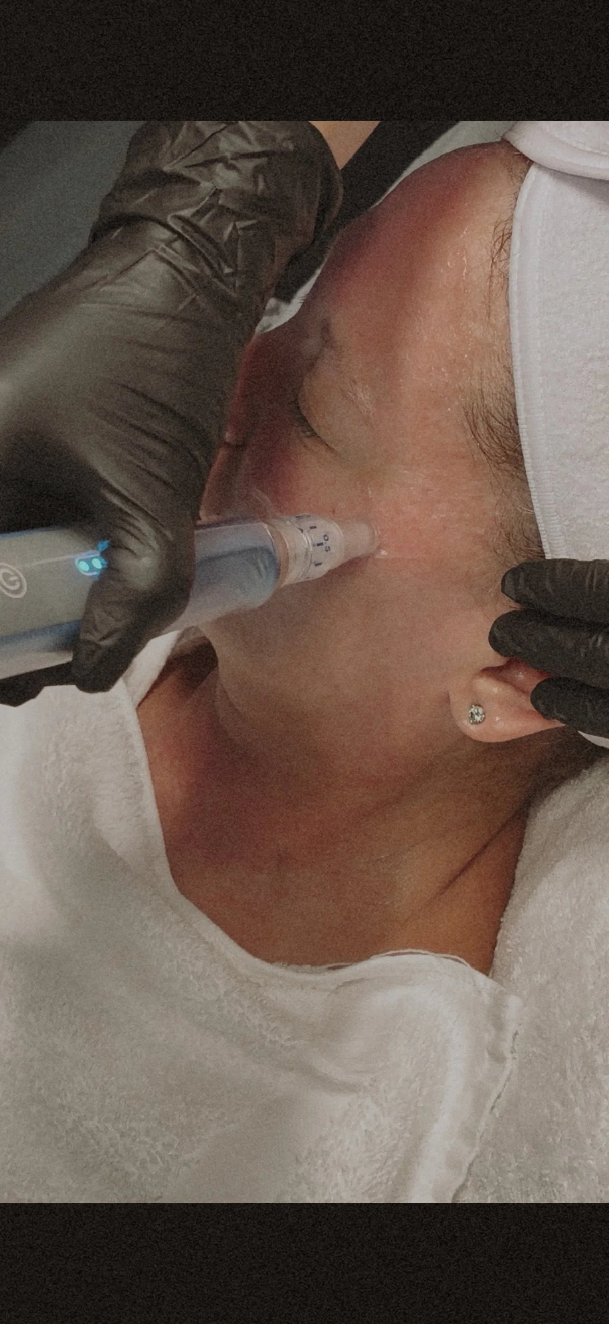 A person receiving a facial treatment with a device on their face, while a person in black gloves adjusts the device.