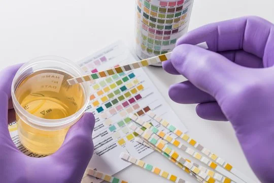 A person wearing purple gloves holding a test strip with yellow and white squares over a small container of yellow liquid, with color comparison charts in the background.