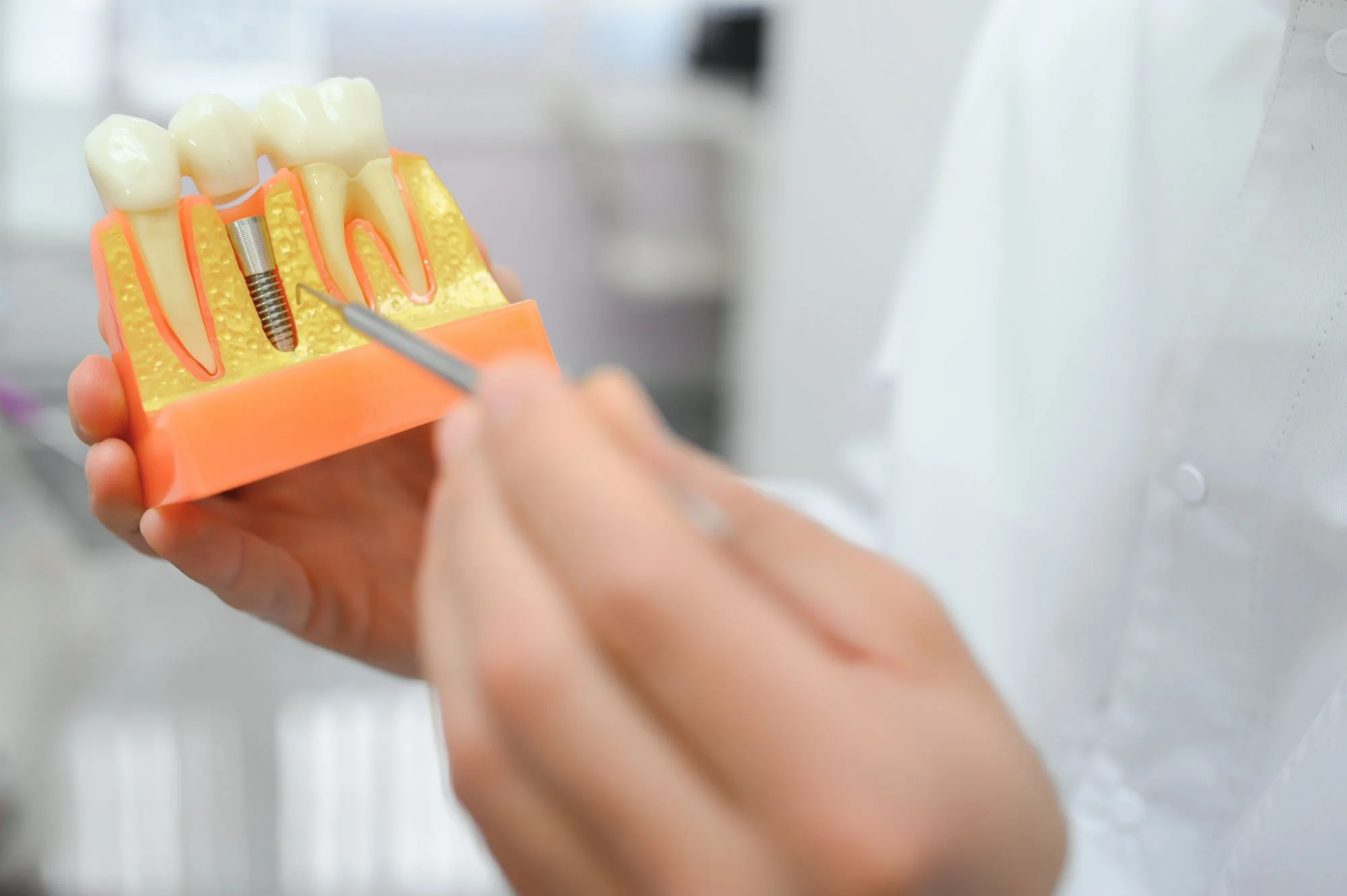 Am I a Candidate for Dental Implants?