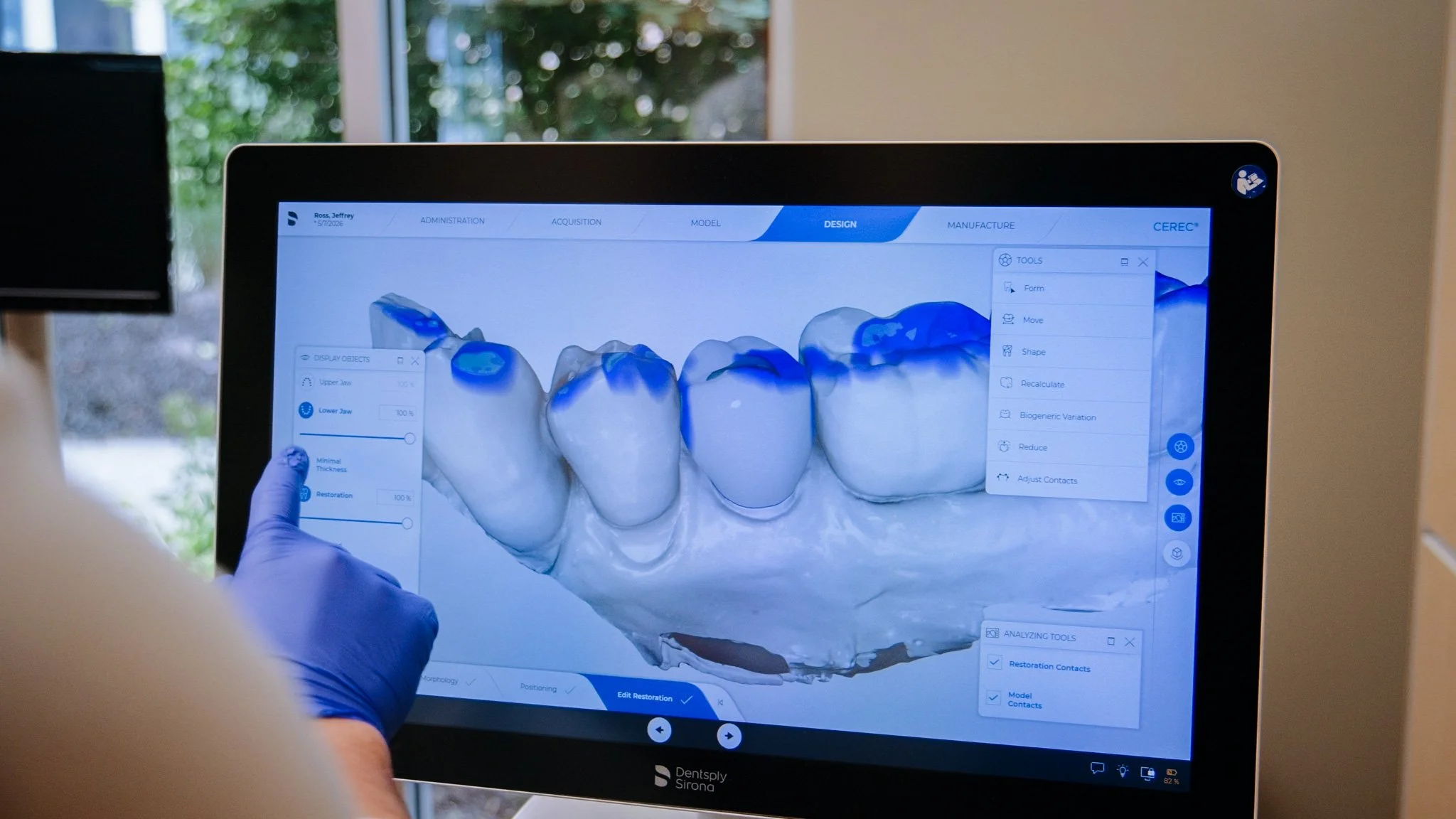 Computer monitor displaying 3D digital dental model of teeth with sidebar tools for editing and analysis.
