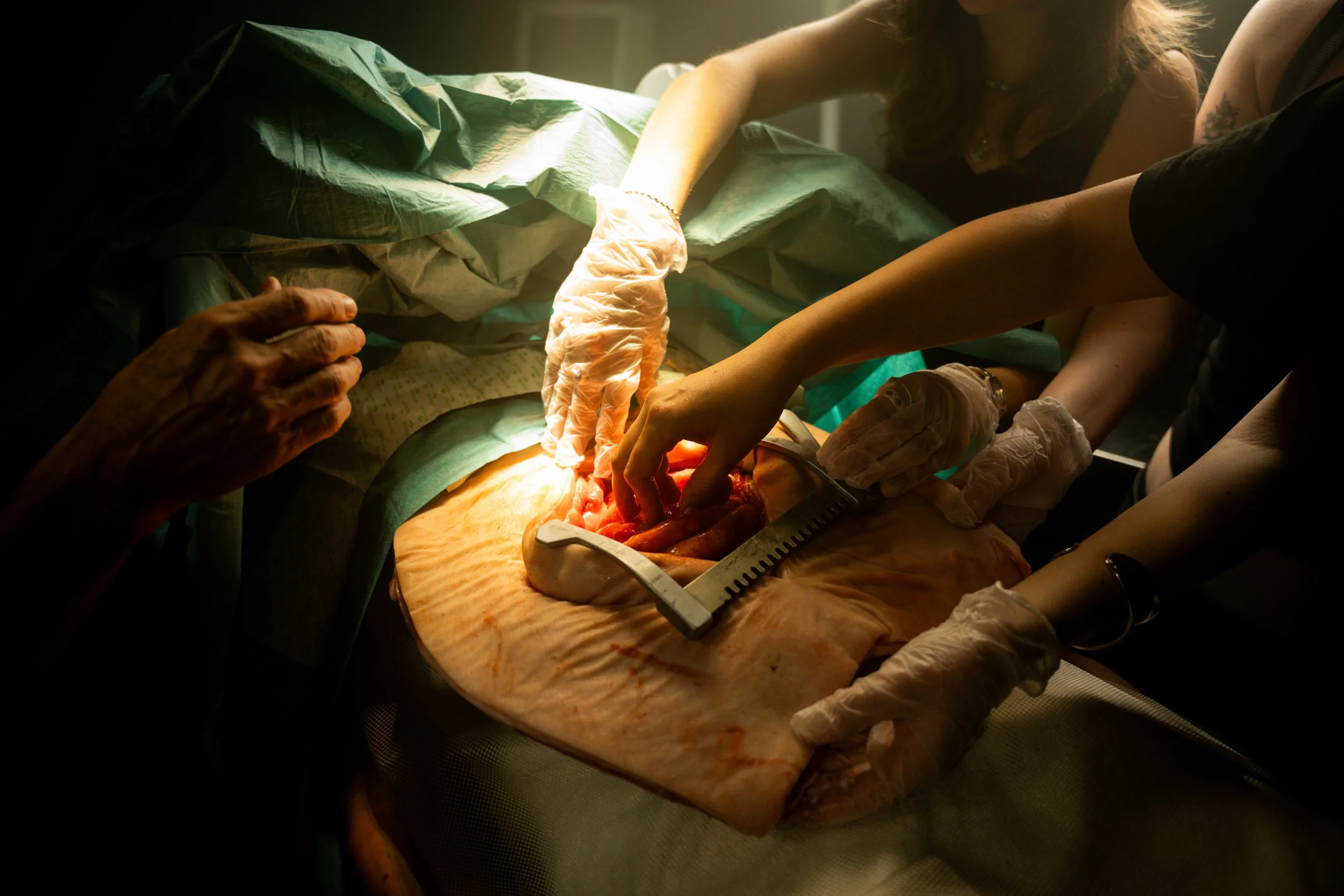 Surgeons perform surgery on a patient's abdomen, with one surgeon's hand guiding the procedure and another assisting. Surgical tools are visible, and the patient is covered with surgical drapes.