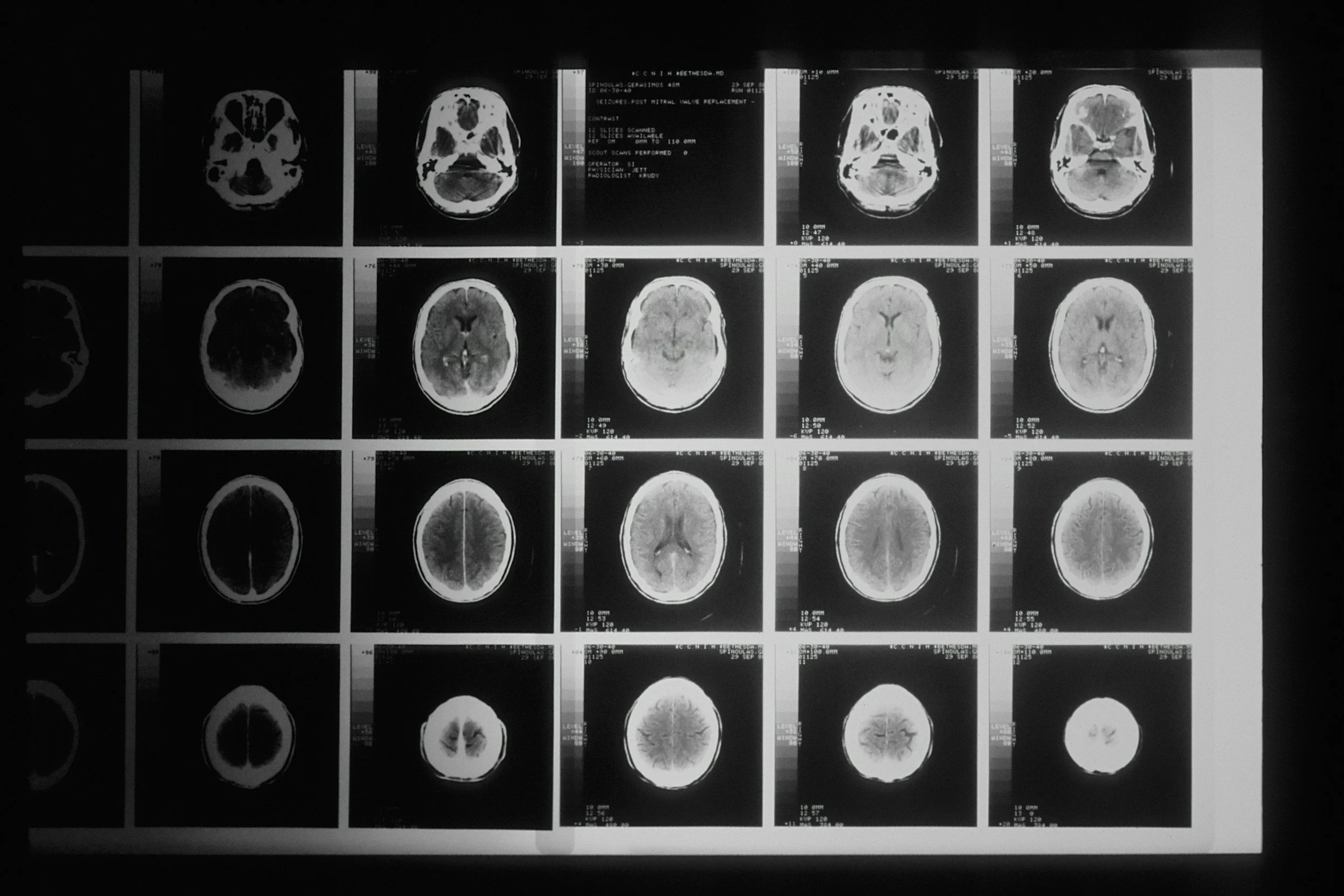 Black and white medical scan images of the brain, displayed in a grid.
