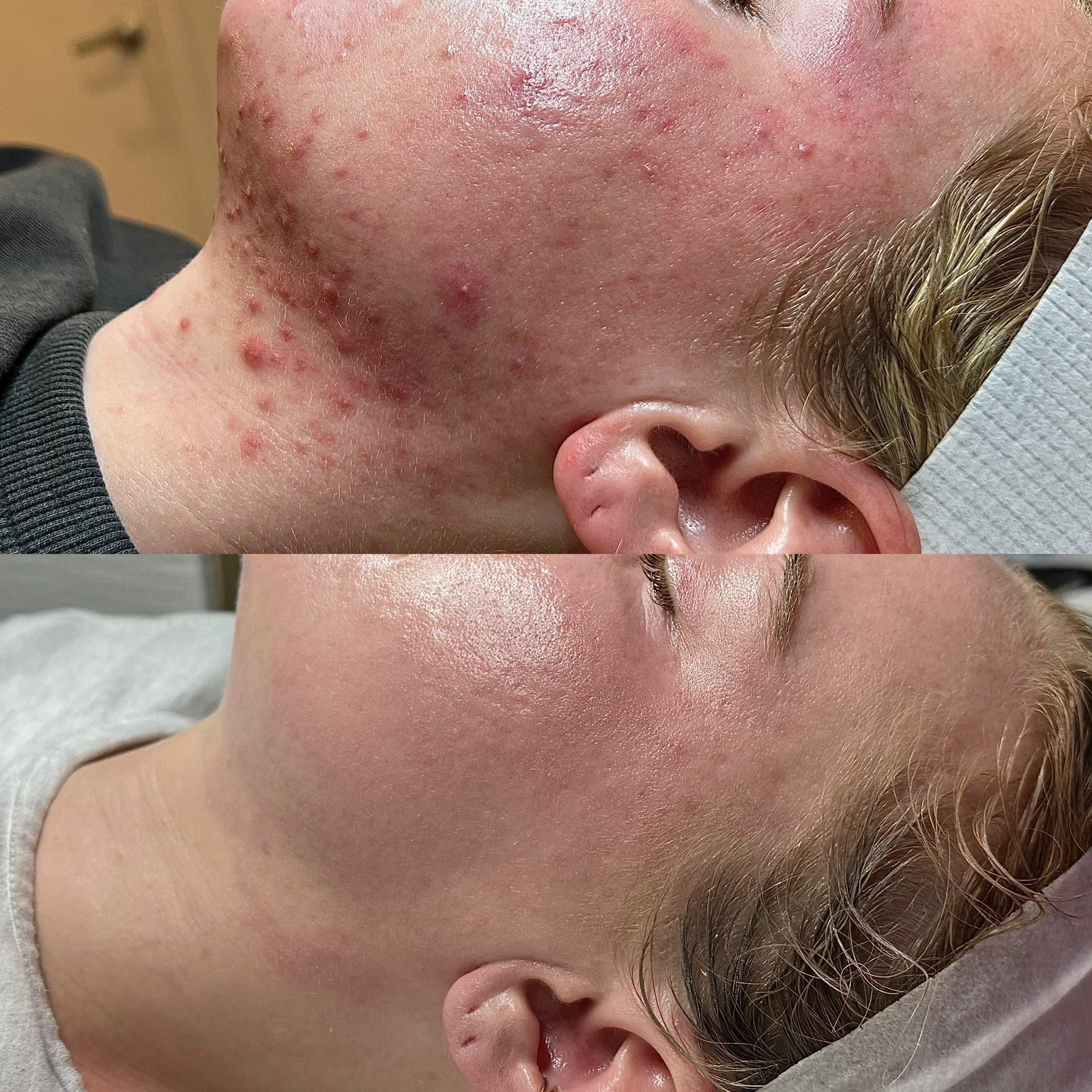 Close-up of a person's face showing skin blemishes and red spots, with a focus on the cheek and side of the face.