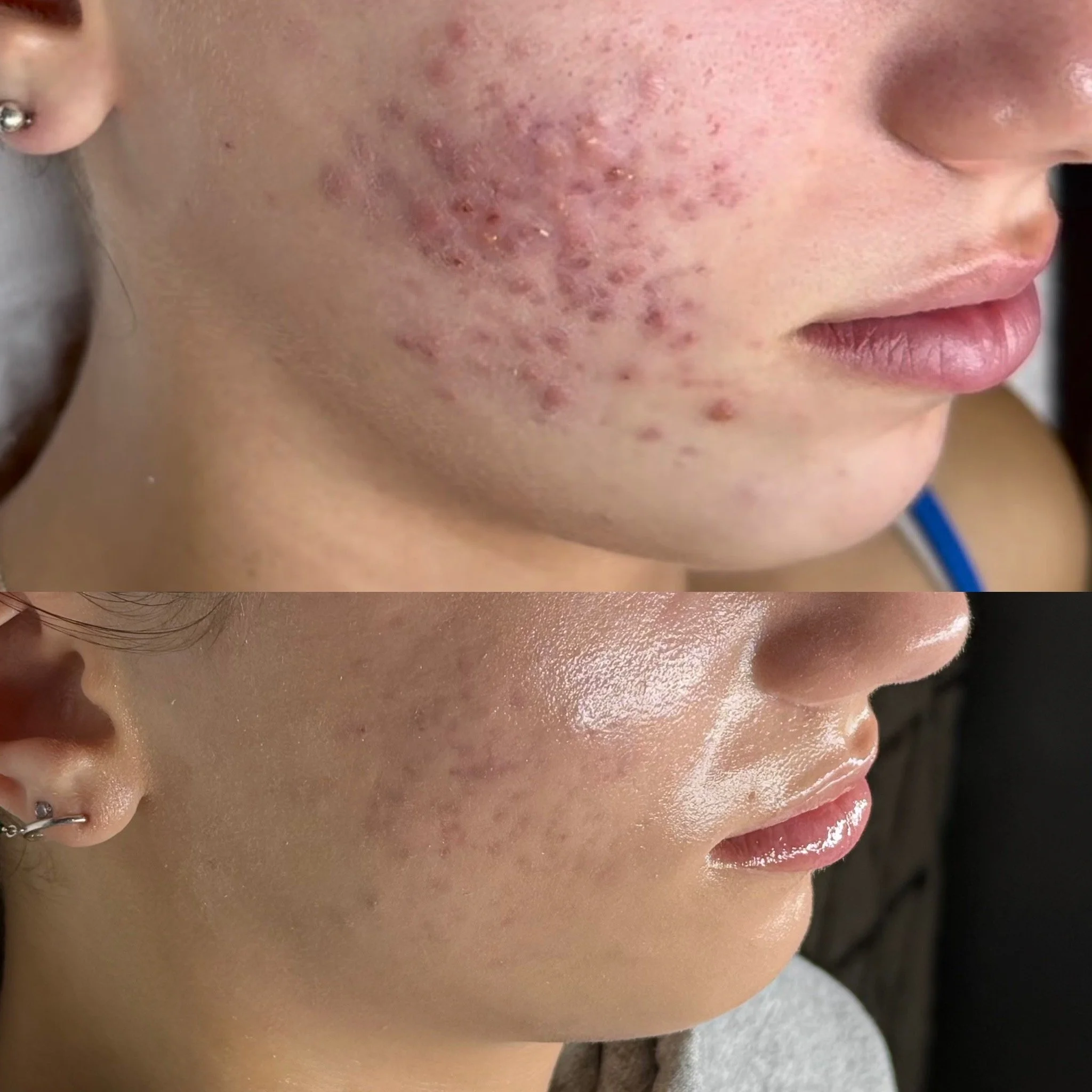 Close-up of a person's face showing skin irritation, redness, and small bumps or pimples on the cheek, near the nose and lips.