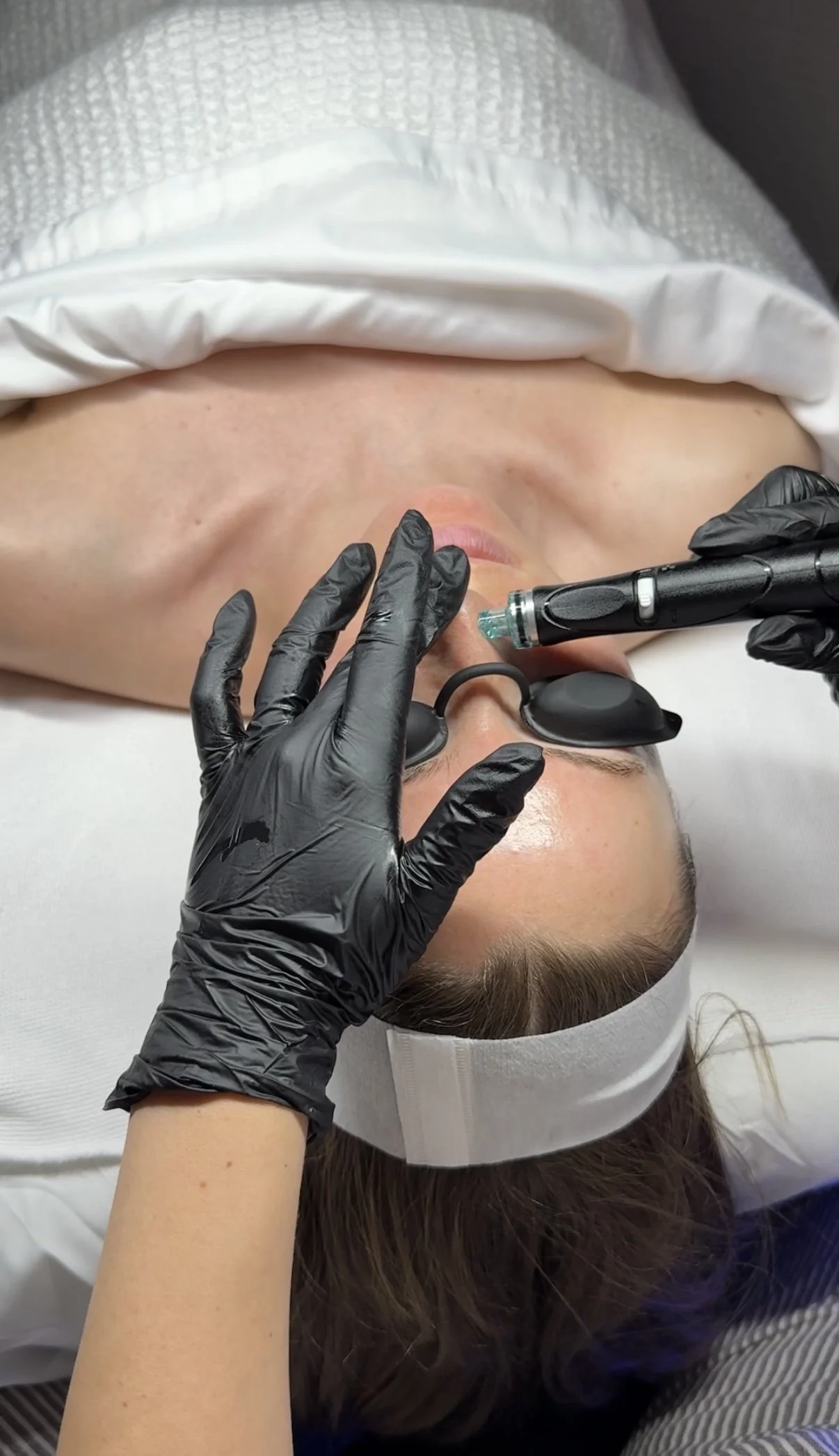 A person lying down with a white headband, receiving a cosmetic or medical treatment on their face from a practitioner wearing black gloves, using a specialized device.