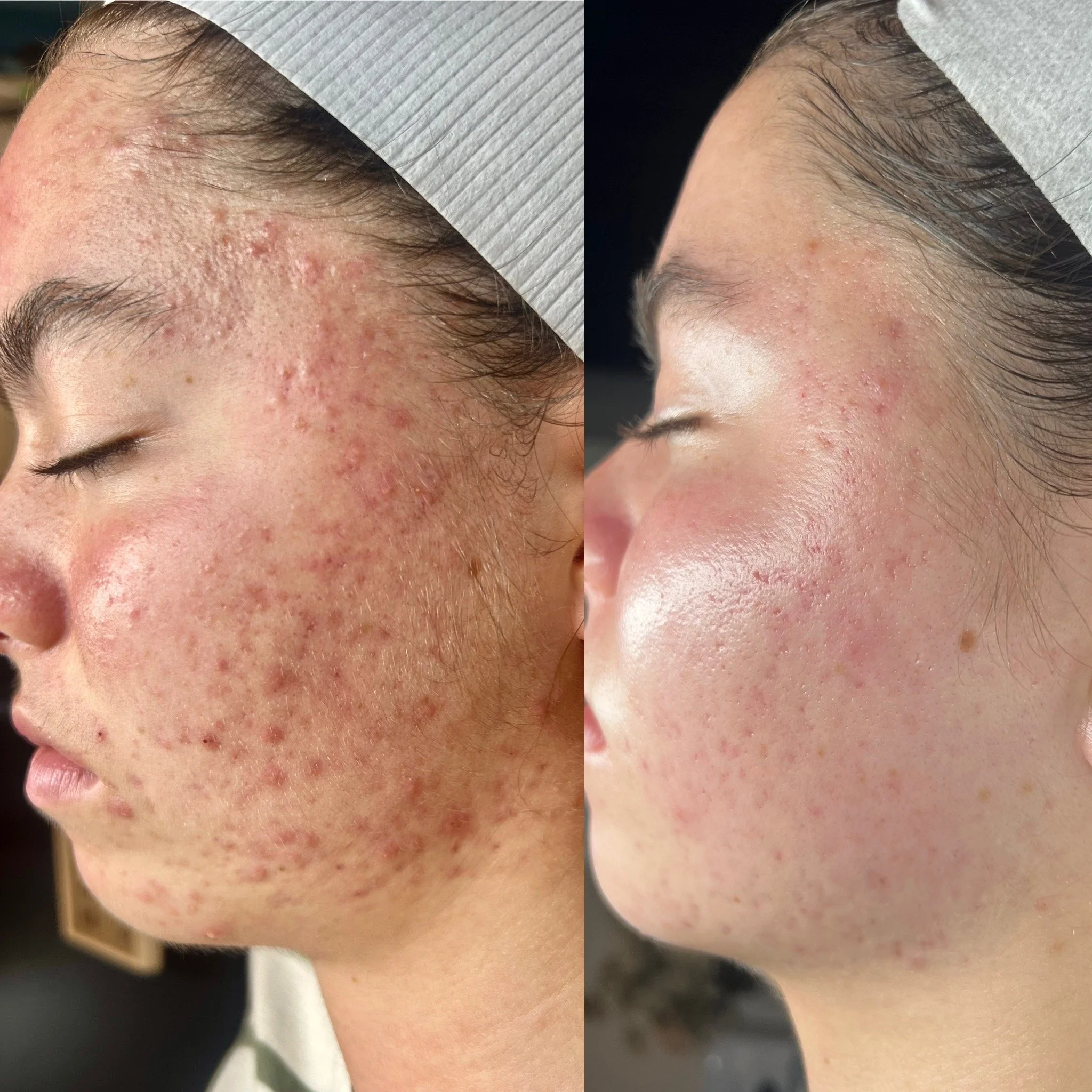 Comparison of a person's forehead before and after skincare treatment, showing reduced acne and smoother skin.