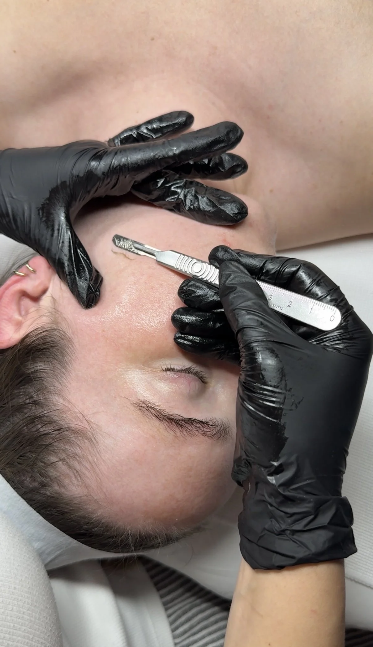 A person with short dark hair receiving a cosmetic procedure on the face, with black-gloved hands holding a scalpel and a ruler.