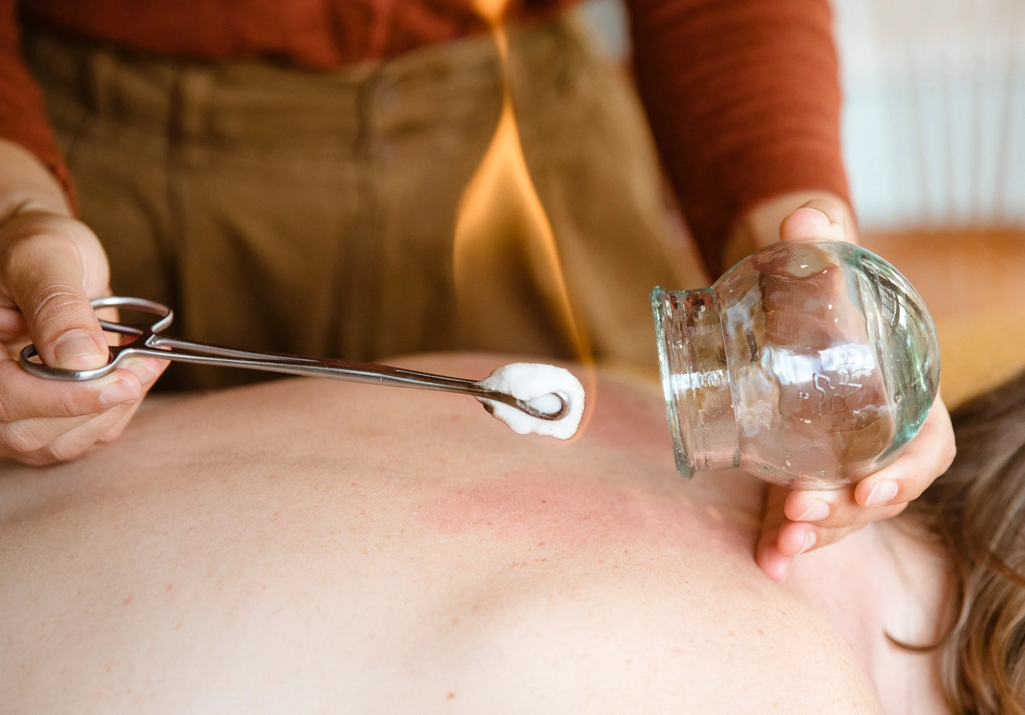 Cupping