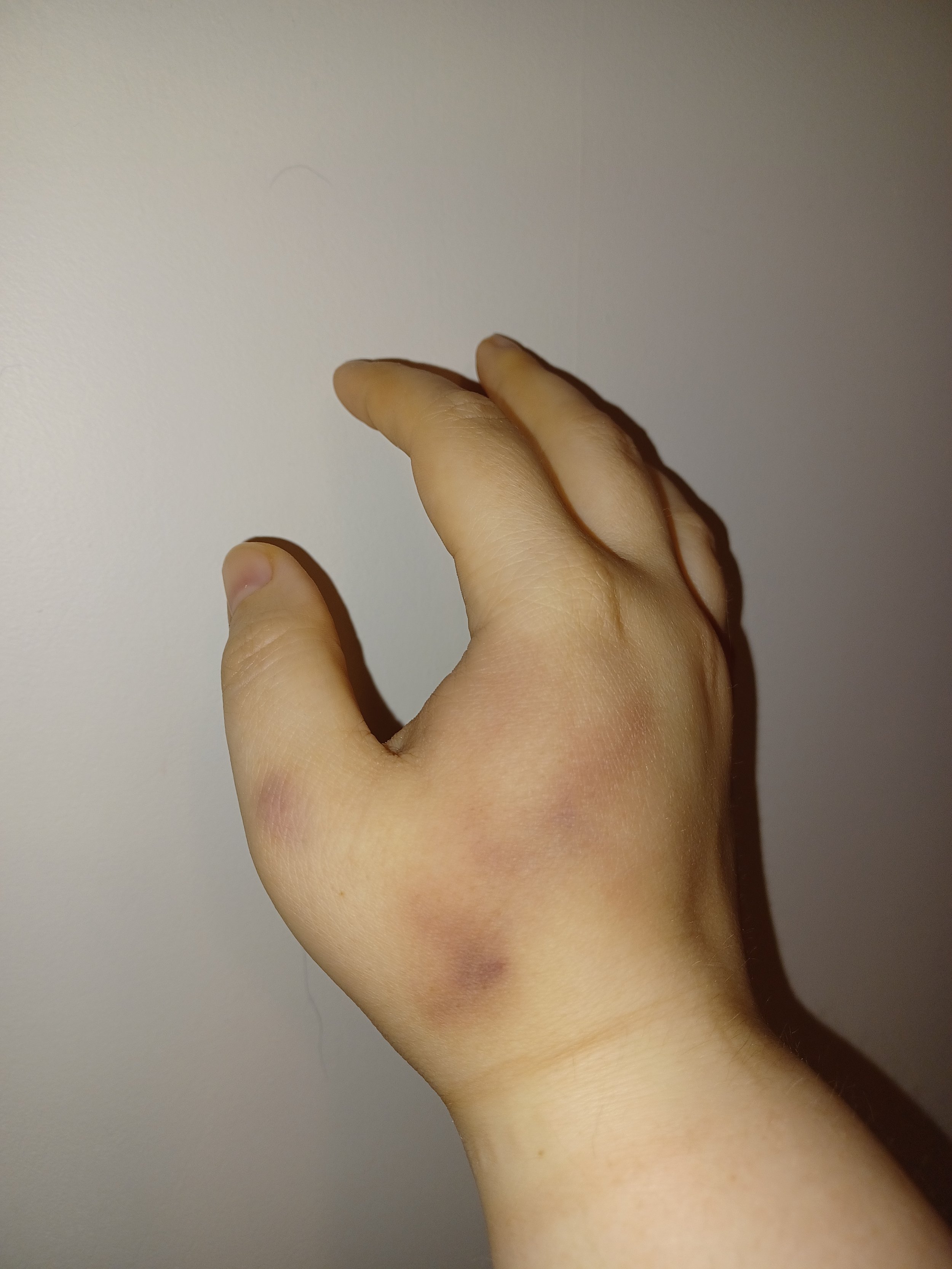 A human hand with light skin tone and some small scars, positioned with fingers slightly apart, against a plain, light-colored wall.