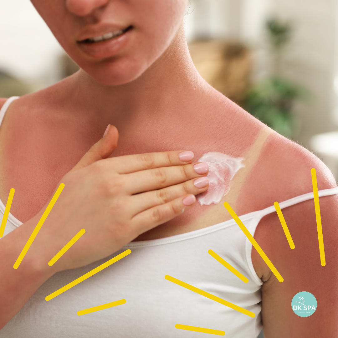 Natural Remedies for Sunburn