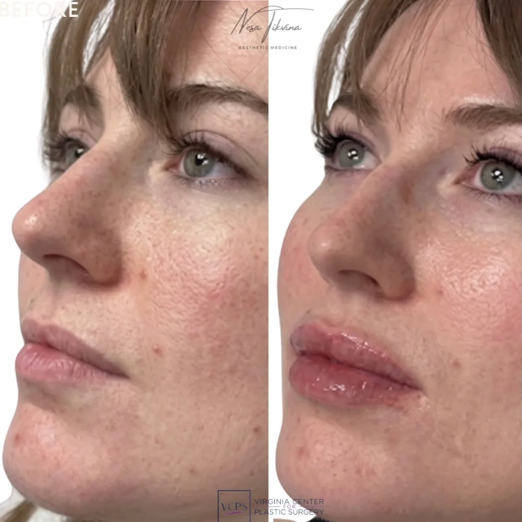 Lip filler &amp; strategic lip framing 

@np_nesa 

👩🏼&zwj;⚕️ Nesa Tikvina, MSN, FNP-BC, CANS (@np_nesa)
Aesthetic Medicine | 📍Alexandria, VA | Link in bio to book

#filler #injectables #injectionsbynesa #medspa #beautytok