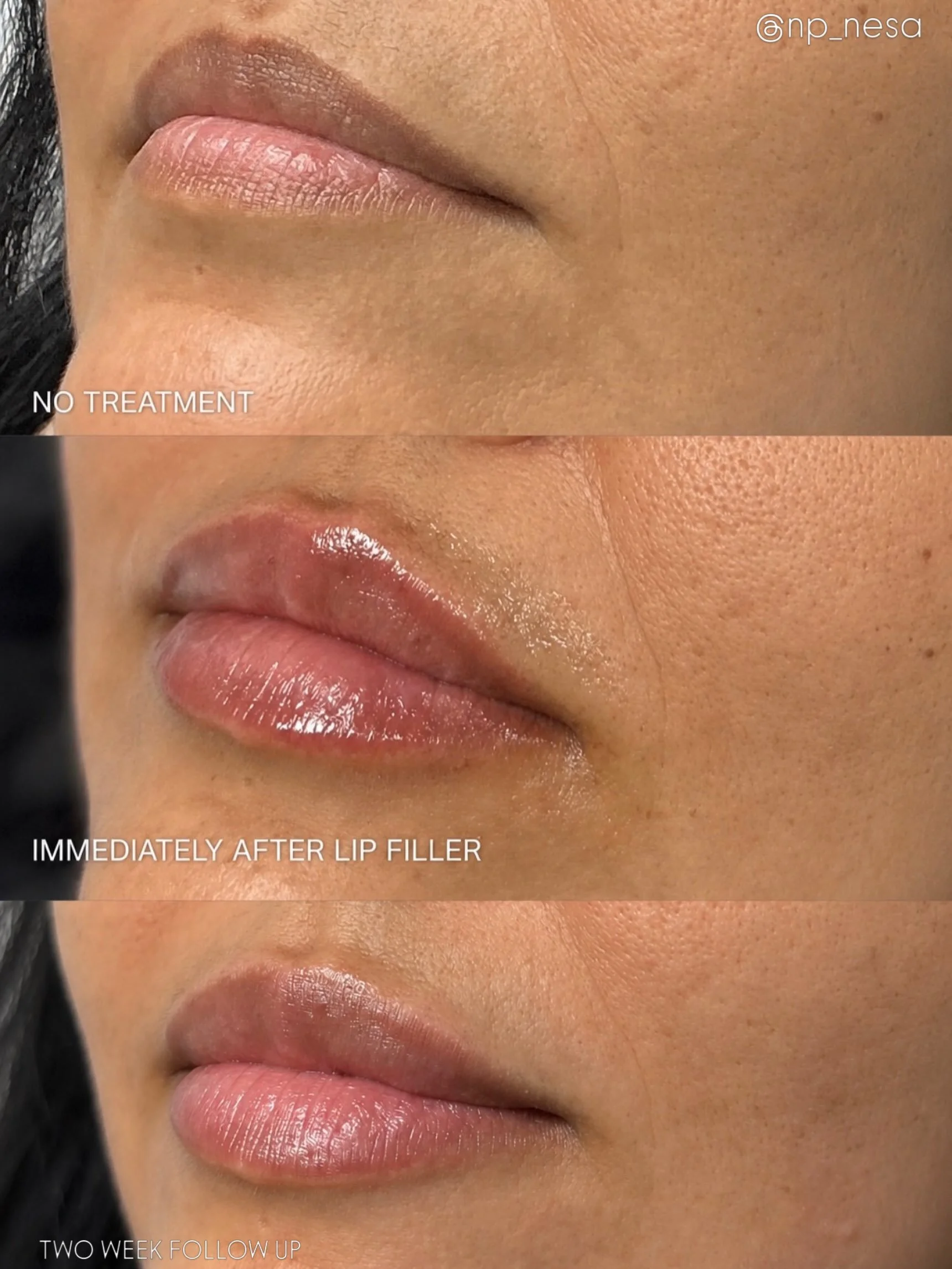 ✨ Realistic filler expectations ✨

Lip filler is meant to enhance not completely change your natural lips.

These photos show:
&bull; Before treatment
&bull; Immediately after filler (swelling is expected!)
&bull; 2-week healed results

The final res