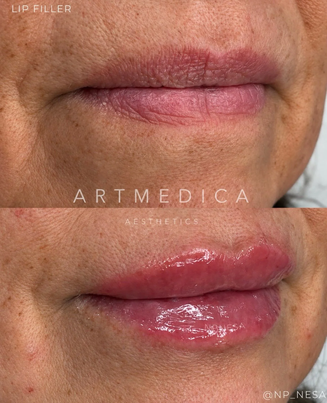 Loving this lip filler result for this mature lip. Some immediate swelling is completely normal and will gradually subside as the lips settle over the next few days
______________________________________________

💉&nbsp;&nbsp;lips&nbsp;&nbsp;&nbsp;&
