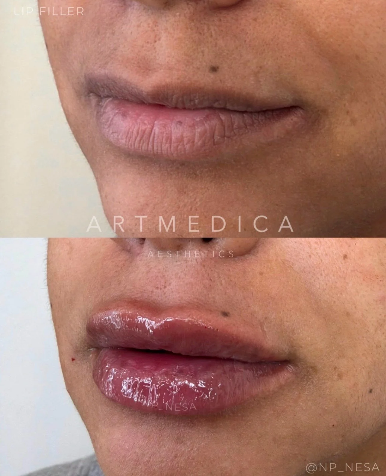 First-time lip filler for this patient. Subtle soft enhancement with immediate swelling, which is expected and will gradually settle as the lips heal.

______________________________________________

💉&nbsp;&nbsp;lips&nbsp;&nbsp;&nbsp;&nbsp;
👩🏼&zw