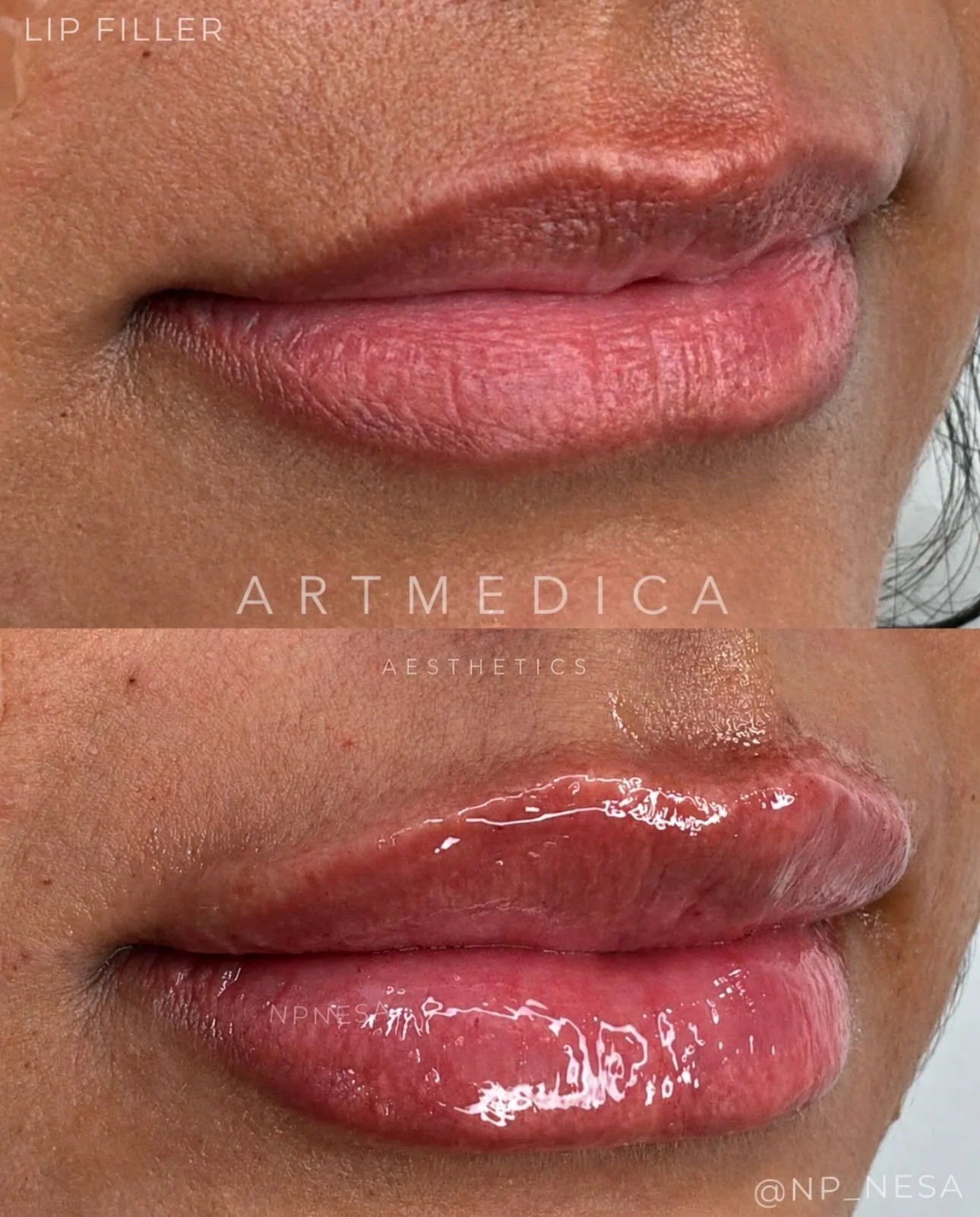 First time lip filler for this patient 🫦

______________________________________________

💉&nbsp;&nbsp;lips&nbsp;&nbsp;&nbsp;&nbsp;
👩🏼&zwj;⚕️ Nesa Tikvina, MSN, FNP-BC

______________________________________________

𖡡 @artmedicaaesthetics | Vie