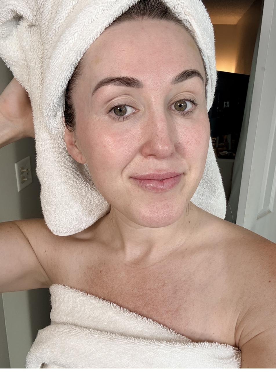 Woman with fresh, glowing skin and no makeup after months of aesthetic treatments