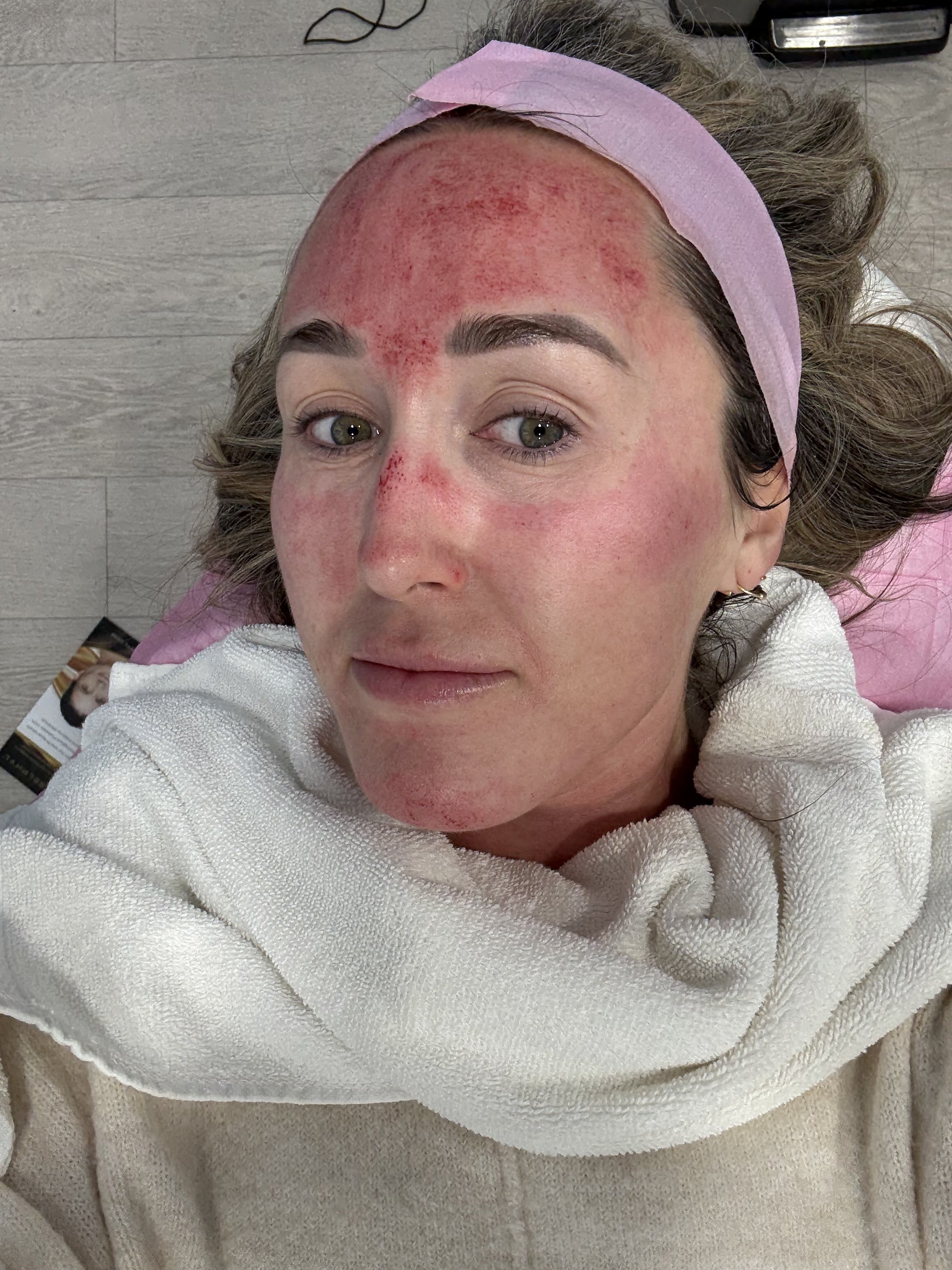 Every Aesthetic Treatment I've Tried, Rated (And the Post Procedure Routine That Got Me Through It)